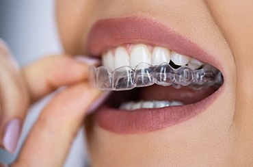 Smiling woman putting on clear aligner