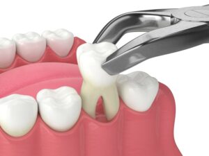 3D diagram of a tooth extraction